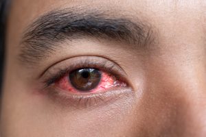 A close-up of a person with a badly inflamed eye.
