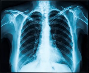 An image of a chest x-ray.